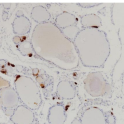 Procalcitonin Rabbit Monoclonal Antibody(ARB533)