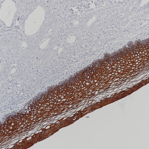 Cytokeratin 5&6 Rabbit Monoclonal Antibody Cocktail(ARB939/ARB940)